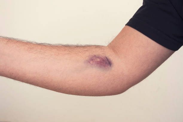 Bruises from blood collection on white background. Close-up image stock photo