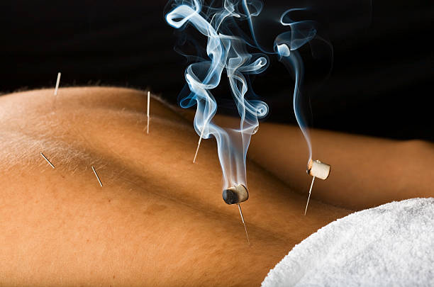 Burning moxa herb on needles stuck to skin stock photo