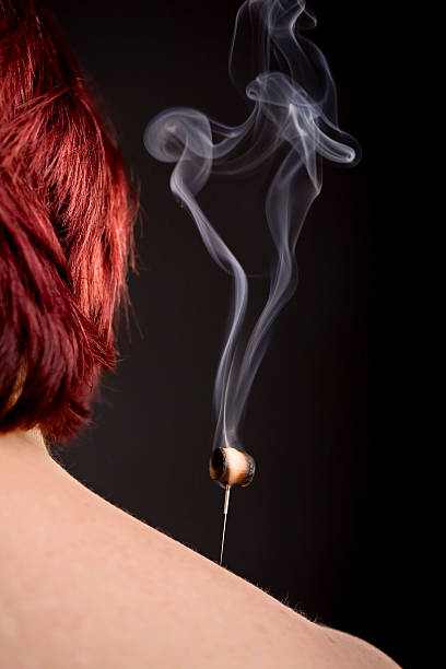 Burning moxa on acupuncture needle stock photo