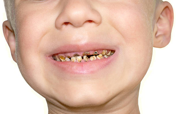 Calf's Teeth decay Toothache Dental Medicine Calf's Teeth decay Toothache because of too many sugar in food Dental Medicine rotten teeth in children stock pictures, royalty-free photos & images