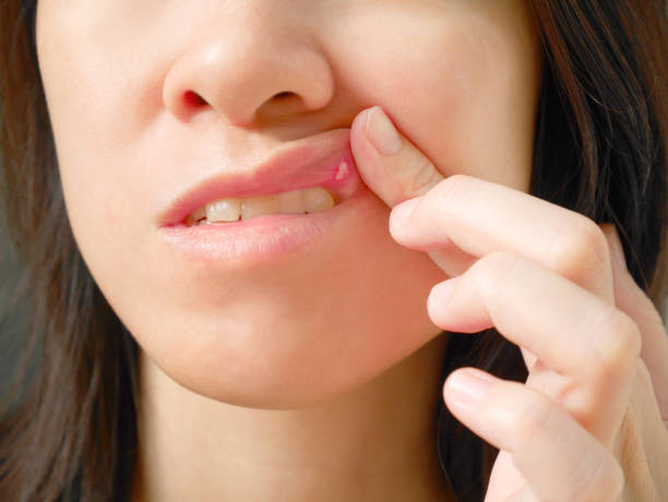 322 Mouth Ulcer Stock Photos, Pictures &amp; Royalty-Free Images - iStock