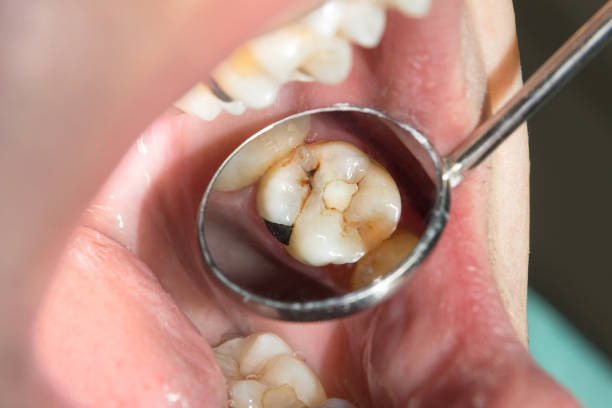caries spoiled tooth closeup photographed caries spoiled tooth closeup photographed through dental mirror rotten teeth in children stock pictures, royalty-free photos & images
