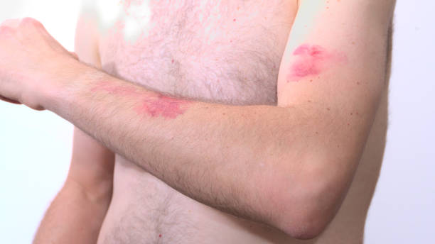 hombre caucásico sintiendo codo con erupción cutánea visible debido a la viruela del mono - monkeypox vaccine fotografías e imágenes de stock