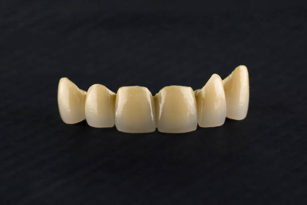 Cermet tooth crowns stock photo