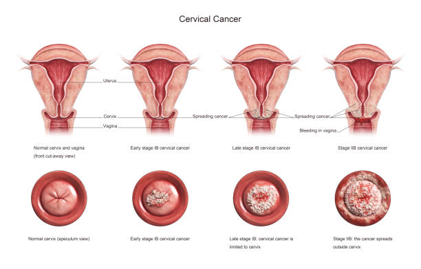 Cervical cancer stages. stock photo