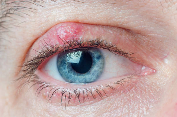 Chalazion on the eyelid of a man close-up stock photo