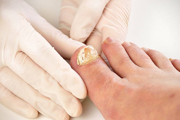 checking the disease big toe Closeup image of podologist checking the left foot toe nail suffering from fungus infection. horizontal studio picture on white background. ugly old women stock pictures, royalty-free photos & images