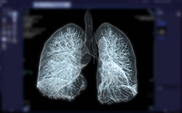 ct 胸部或肺3d渲染圖像診斷結核病,結核和共存-19 。 - 淋巴結 插圖 個照片及圖片檔