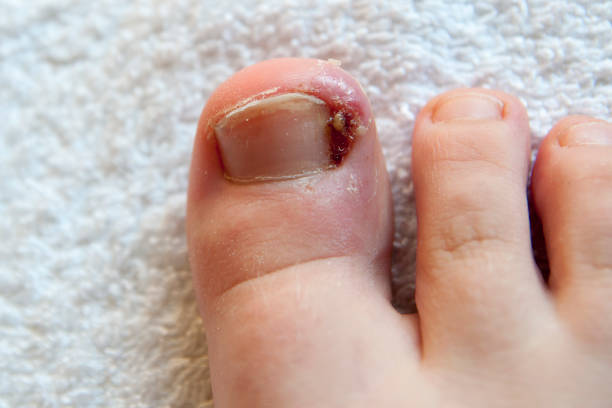 Child foot: onychocryptosis - an ingrown toenail Close up of a child foot and fingers: painful problems with an ingrown nail. toenail stock pictures, royalty-free photos & images