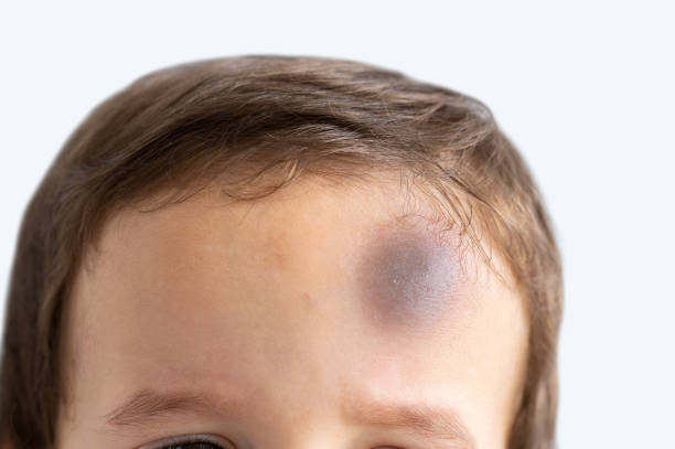 child with bump on the forehead Close-up of a boy with injury on head bumpy stock pictures, royalty-free photos & images