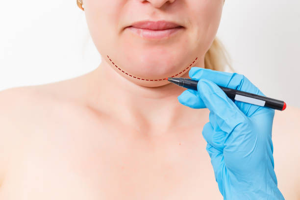 Chin reduction augmentation double chin removal plastic surgery cosmetic operation concept Woman eyes closed waiting doctor surgeon hands to draw the cut line the double chin isolated white background stock photo