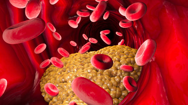 Cholesterol formation, fat, artery, vein, heart. Narrowing of a vein for fat formation Cholesterol formation, fat, artery, vein, heart. Red blood cells, blood flow. Narrowing of a vein for fat formation, 3d render cholesterol stock pictures, royalty-free photos & images