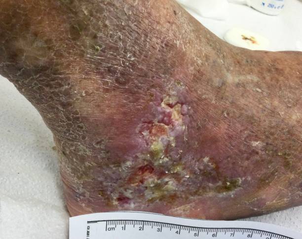 Chronic infected ulceration Chronic infected ulceration on diabetic foot with chronic dermatitis and chronic venous insufficiency foot exam diabetes stock pictures, royalty-free photos & images