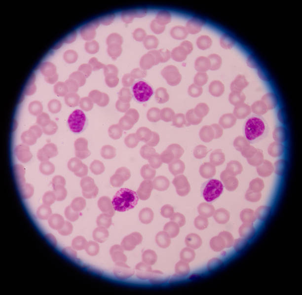 Chronic lymphocytic leukemia is a type of cancer of the blood and...