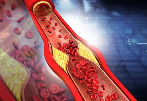 Causes-of-Blood clotting