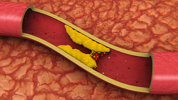 Clogged Artery (3D)  cholesterol stock pictures, royalty-free photos & images