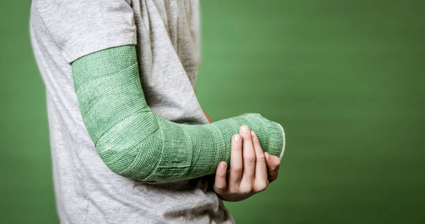 close photo of broken arm with green plaster stock photo