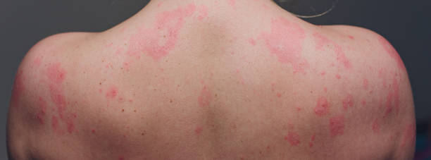 Close up Allergy rash, Around Back view of human with dermatitis problem of rash ,Allergy rash and Health problem. stock photo
