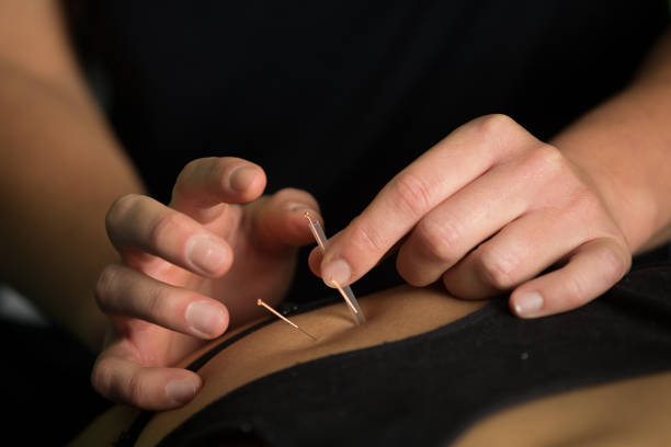 A close up image of a patient getting acupuncture stock photo