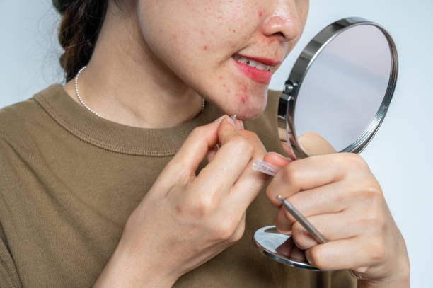 Close up of Asian woman trying to squeeze acne by using acne needle while looking mini mirror. stock photo