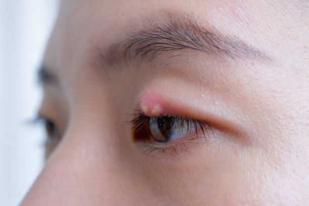 close-up van de aziatische jonge vrouw met bruin oog met strontje infectie. het abces van het ooglid, hordeolum in medische gezondheid, ziekte en behandelingsconcept. - abces stockfoto's en -beelden