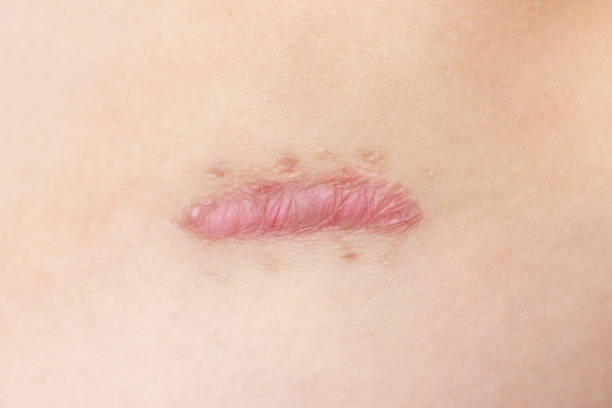 Close up of cyanotic keloid scar caused by surgery and suturing, skin imperfections or defects. Hypertrophic Scar on skin, dermatology and cosmetology concept stock photo