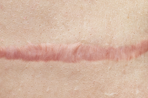 Close up of cyanotic keloid scar caused by surgery and suturing, skin imperfections or defects. Hypertrophic Scar on skin, dermatology and cosmetology concept.