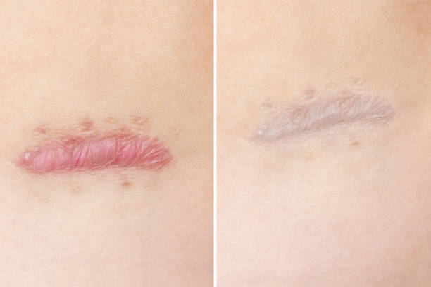 Close up of cyanotic keloid scar caused by surgery and suturing, skin imperfections or defects before and after treatment and laser removal. Hypertrophic Scar on skin, dermatology and cosmetology stock photo
