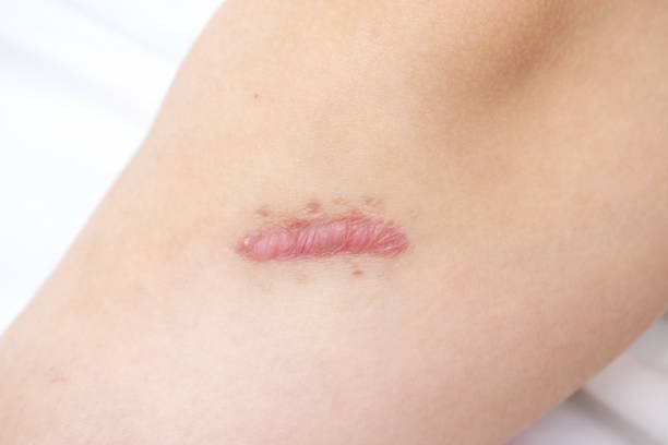 Close up of cyanotic keloid scar on leg caused by surgery and suturing, skin imperfections or defects. Hypertrophic Scar on skin, dermatology and cosmetology concept stock photo