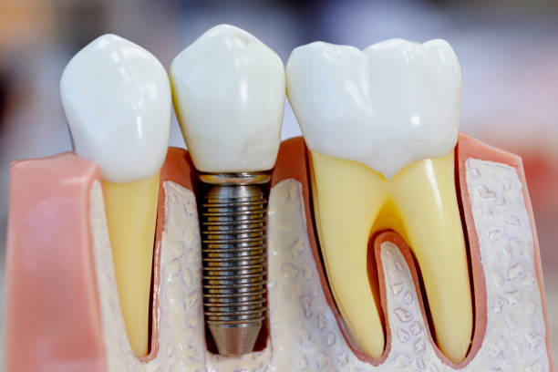 close up portrait of dental modell mit implantation - zahnimplantat stock-fotos und bilder