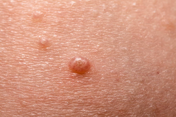 Close up of Molluscum Contagiosum also called water wart stock photo