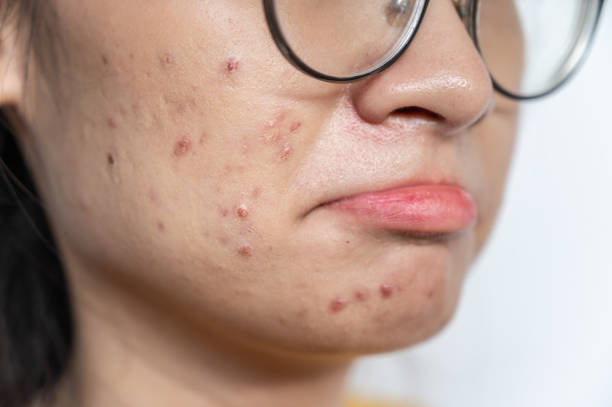 Close up of worried Asian woman having acne inflamed on her face. stock photo