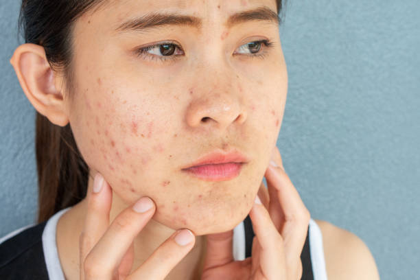 Close up of worrying woman with problems of acne inflammation (Papule and Pustule) on her face. Conceptual of problems on woman skin. ugly girl stock pictures, royalty-free photos & images