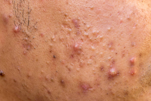 Close up photo of nodular cystic acne blemish spots skin on man face stock photo