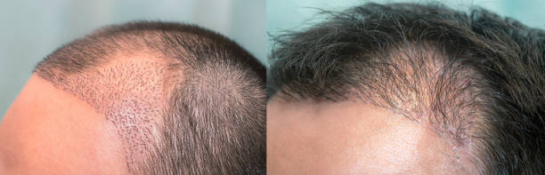 Close up top view of a man's head with hair transplant surgery with a receding hair line. -  1-5 months after Bald head of hair loss treatment stock photo