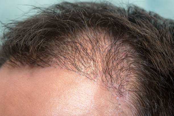 Close up top view of a man's head with hair transplant surgery with a receding hair line. -  5 months after Bald head of hair loss treatment. stock photo