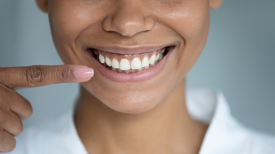 Close up african woman point finger at perfect straight hollywood white toothy smile.  After whitening dental treatment procedure showing result, health stomatology dentistry service, oralcare concept