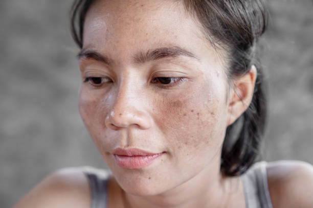 Burn Spots Or Scabs From Laser Treatment Acne Skin, Freckles, Freckles And  Dark Spots On The Face And Neck Of Asian WomenStock Photo, Picture And  Royalty Free ImageImage 110676210.