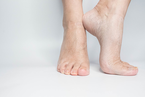 Close-up female sore skin of feet, dry heels isolated on a white background