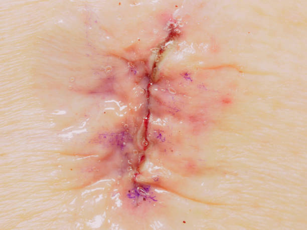 Close-up Image od Lumbar Laminenecotomy Incision Covered with Derma-Bond Glue stock photo