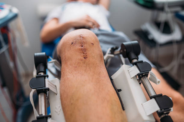 Close-up Of A Patient's Scar After Knee Surgery stock photo