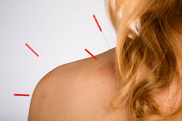 A closeup of a woman receiving acupuncture in her shoulder stock photo