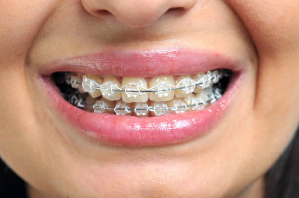 Close-up of ceramic and metallic braces on teeth. Orthodontic Treatment. Dental Care stock photo