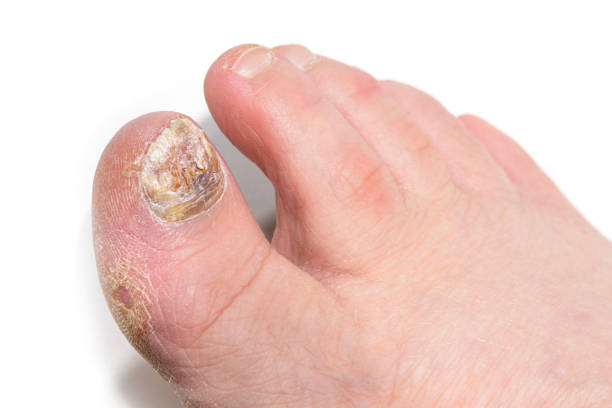 ingrown toenail podiatrist