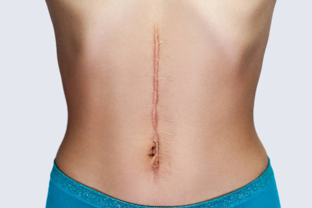 closeup-of-young-woman-with-large-scar-after-surgery