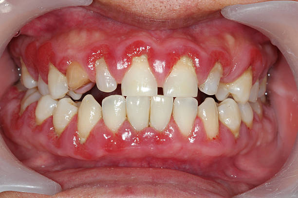 A close-up shot of someone suffering from gingivitis stock photo