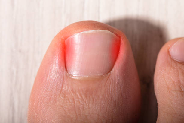 Close-up Sore Toe Nail High Angle View Of Sore Toe Nail On Floor toenail stock pictures, royalty-free photos & images