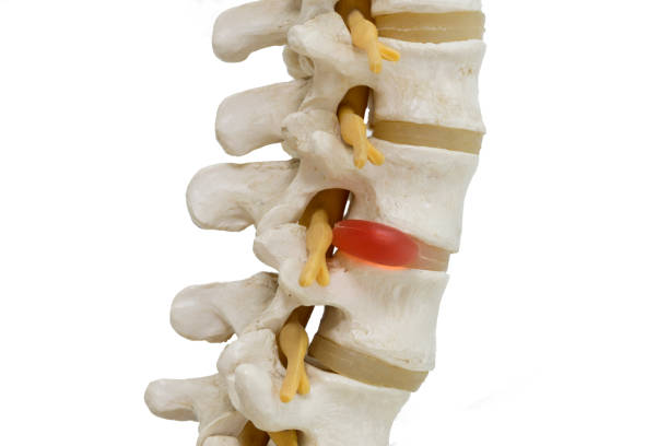 Close-up view of herniated lumbar vertebral disc model Human lambar spine model demonstating herniated disc pressure to nerve root , pressure causing back pain anatomical model photos stock pictures, royalty-free photos & images