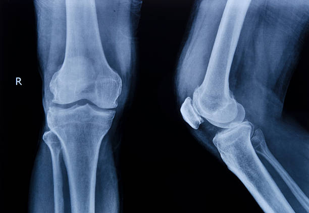 sammlung von x-ray normalen knie - röntgenbild stock-fotos und bilder