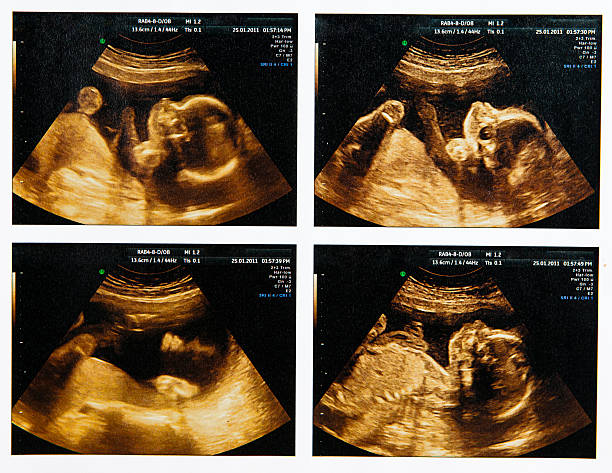 Compilation of four fetus ultrasounds stock photo